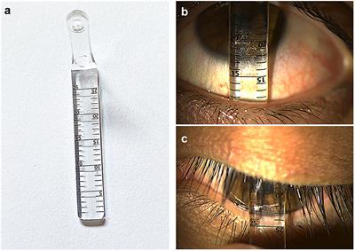 A Review of Clinical Disease Scoring Systems for Cicatricial Diseases of the Conjunctiva